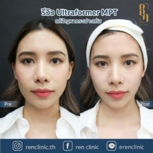 ren-ultraformermpt-review (4)