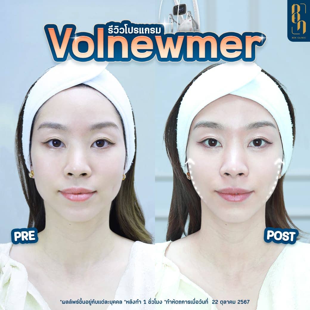 มีร่องแก้ม