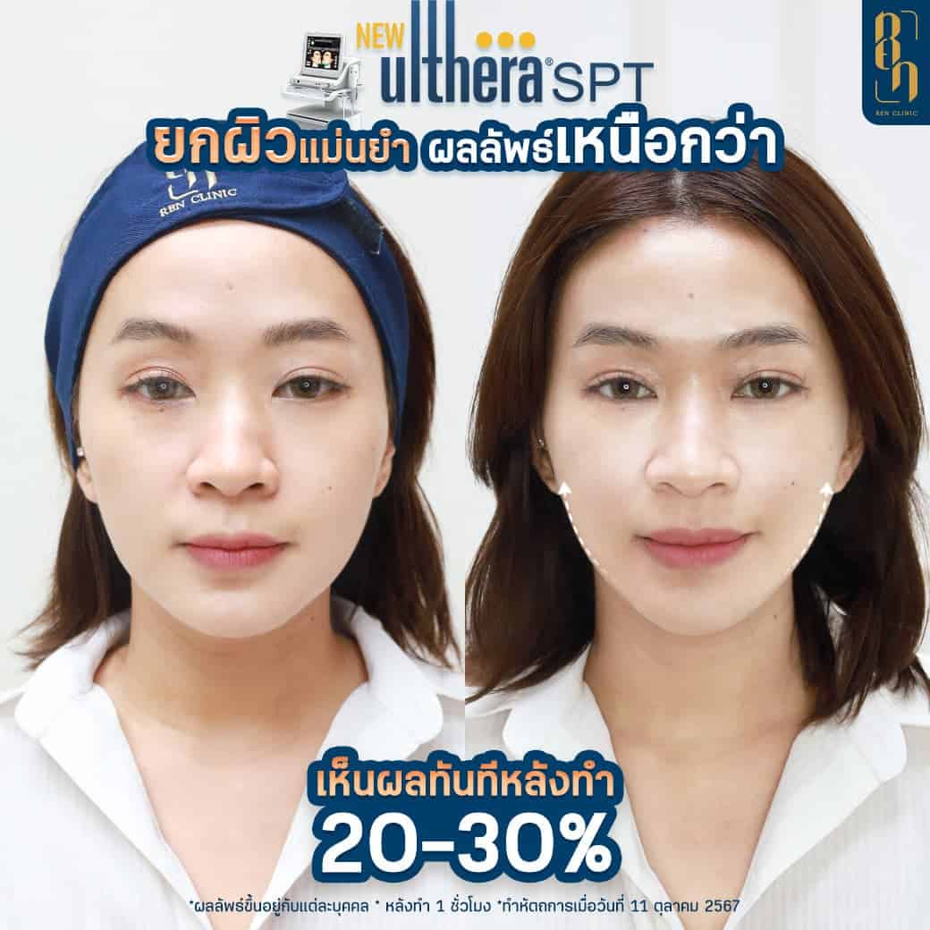 แก้ปัญหาร่องแก้ม