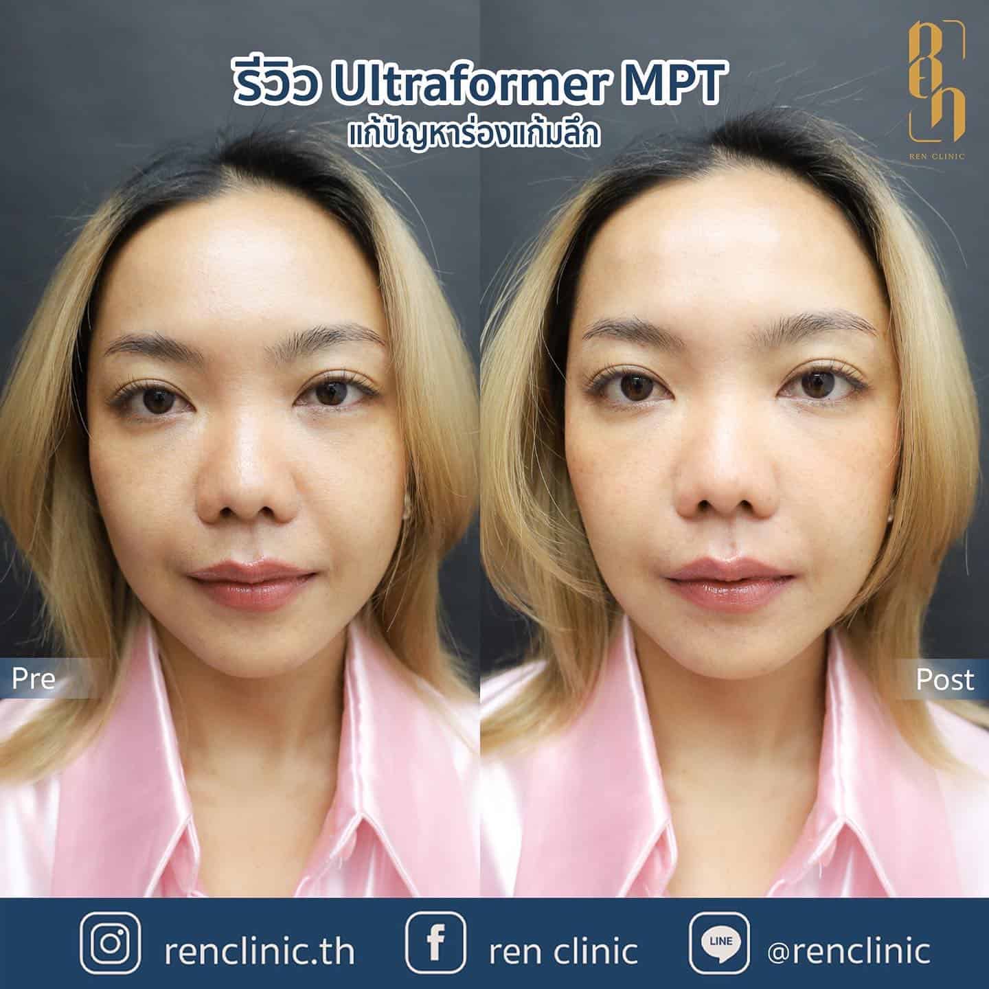 เปรียบเทียบ Ultraformer MPT ก่อน-หลังทำ