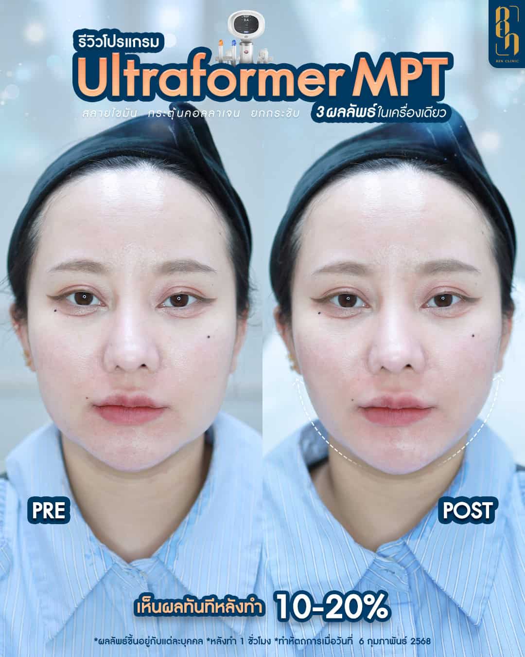 ผลลัพท์หลังทำ Ultraformer MPT