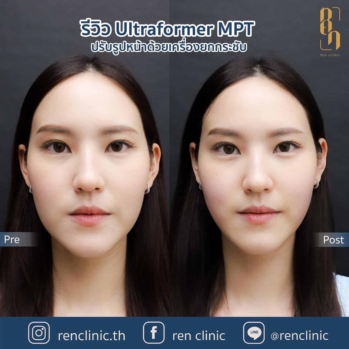 ผลลัพธ์การทำ Ultraformer MPT