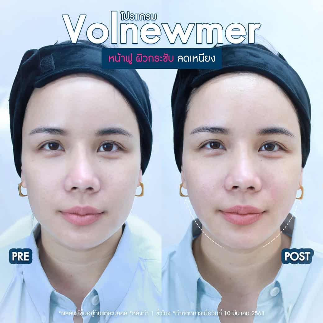 รีวิว Volnewmer ดีไหม
