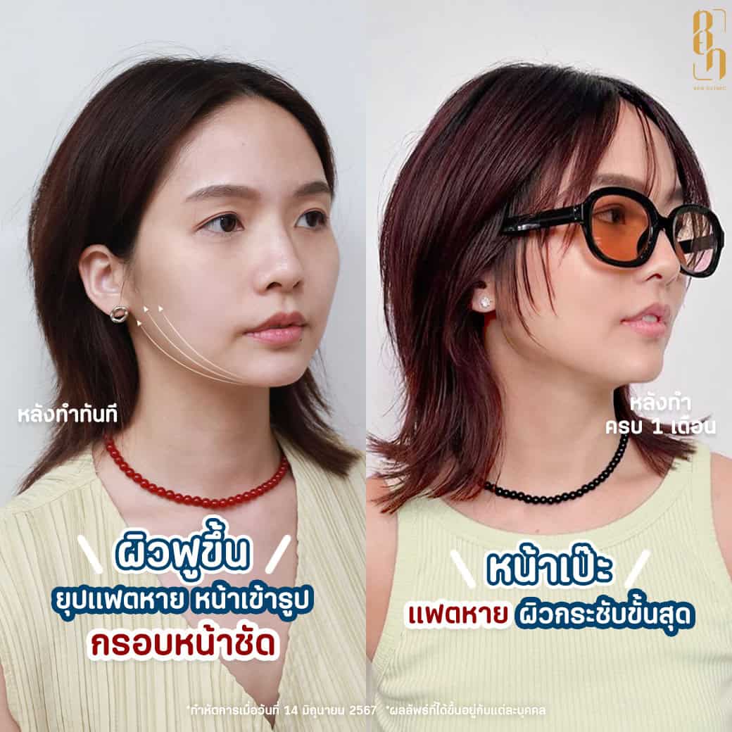 รีวิว Volnewmer