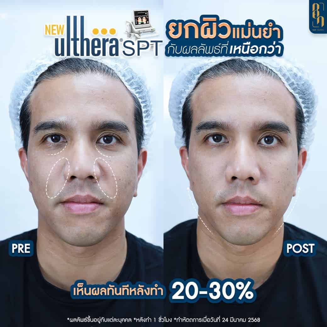 Ulthera SPT รีวิว