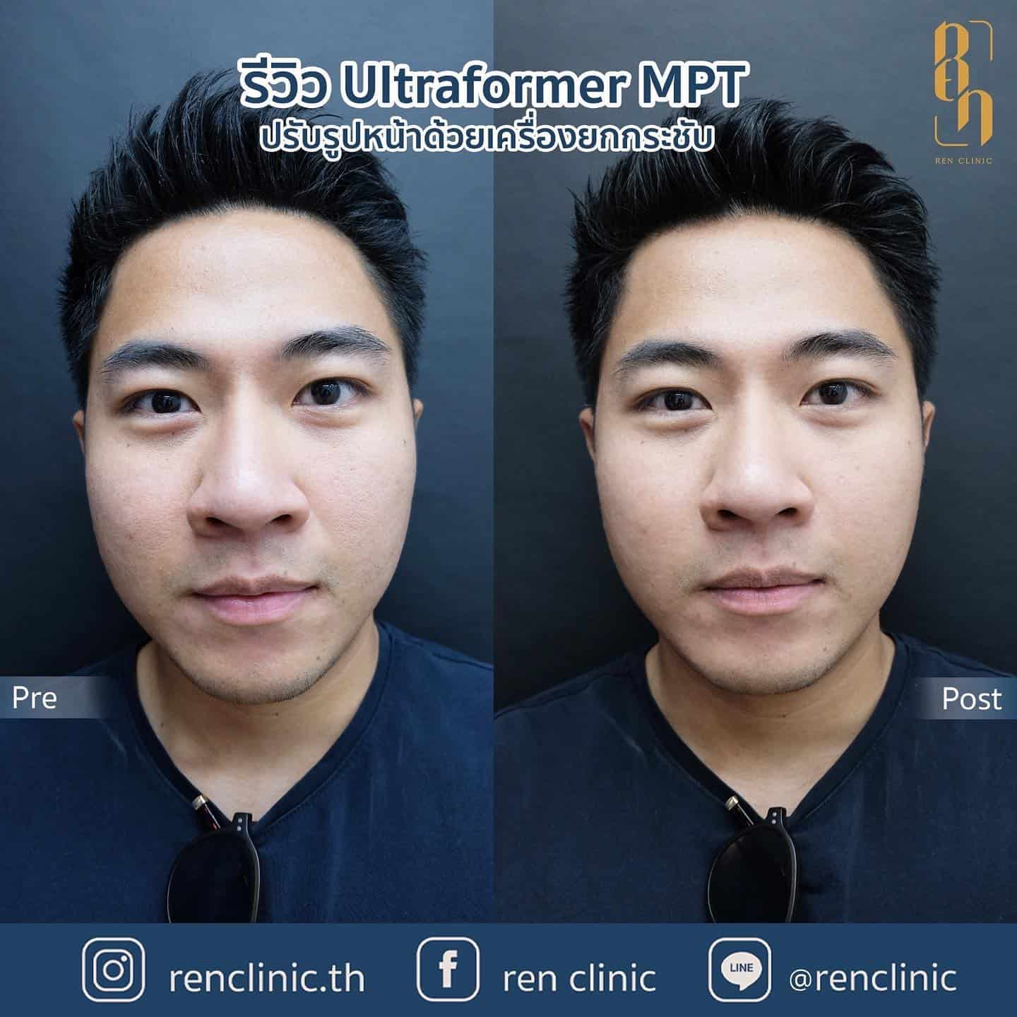 Ultraformer MPT ก่อน-หลังทำ