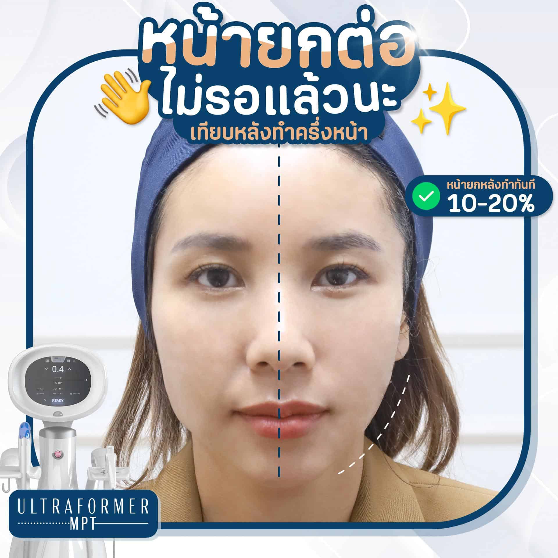 Ultraformer MPT ก่อน-หลังทำ