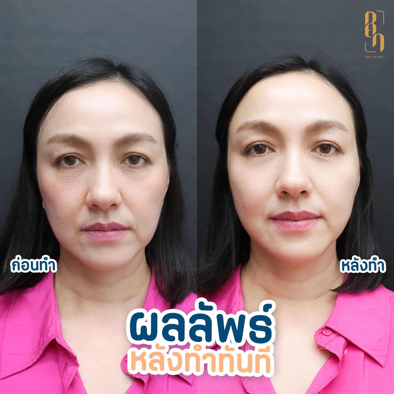 ultraformer mpt รีวิว