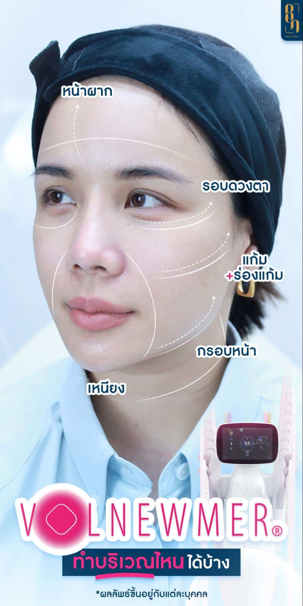 ประโยชน์ของ Volnewmer