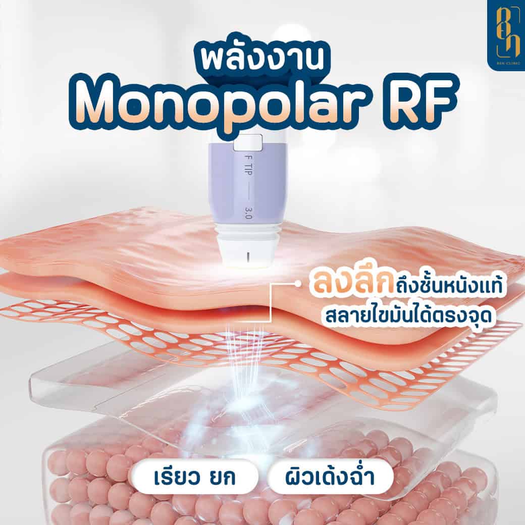 เครื่อง Volnewmer
