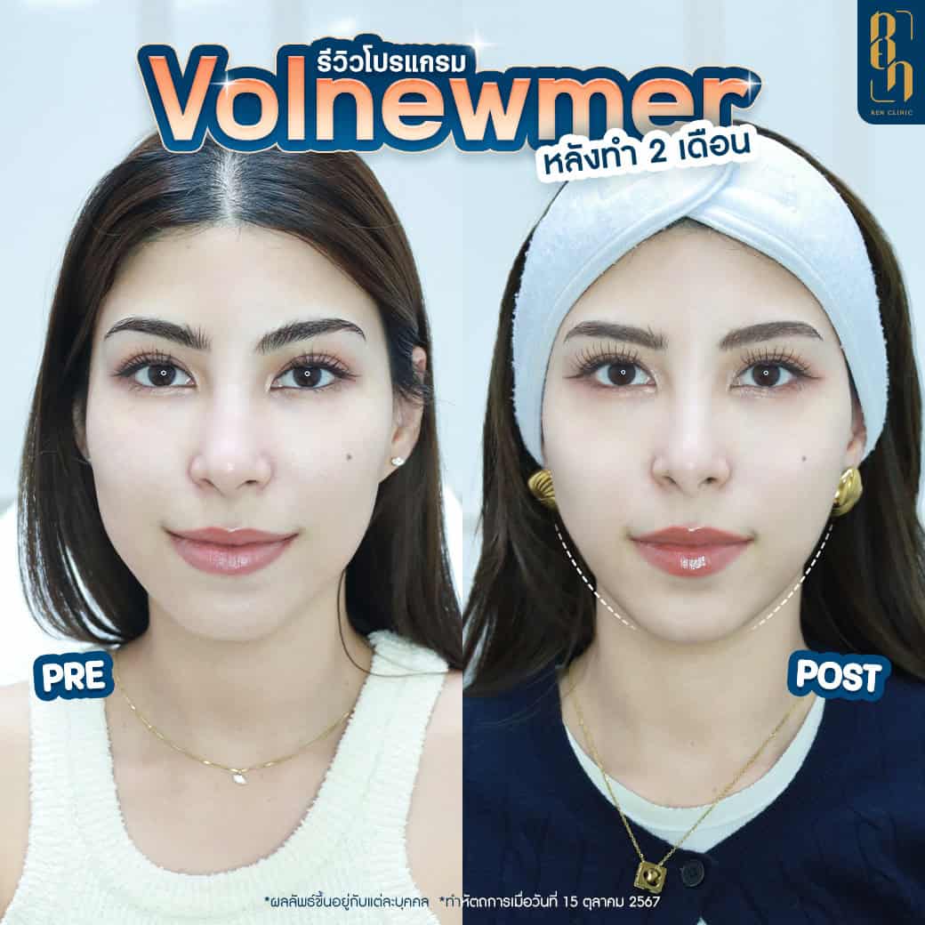 Volnewmer รีวิว