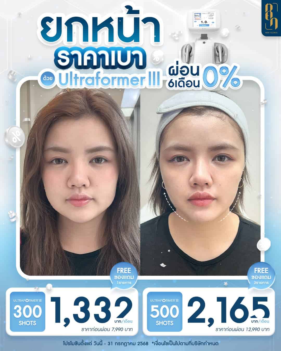 HIFU ราคาเท่าไหร่