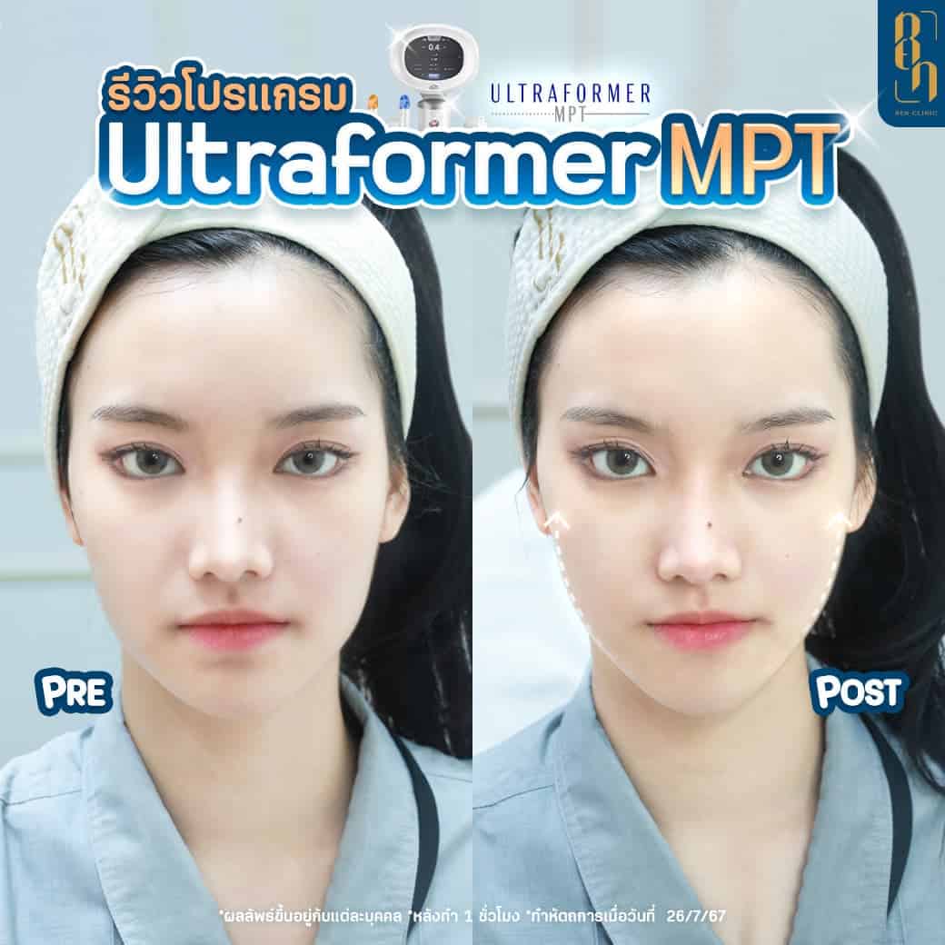 เครื่อง HIFU ราคา