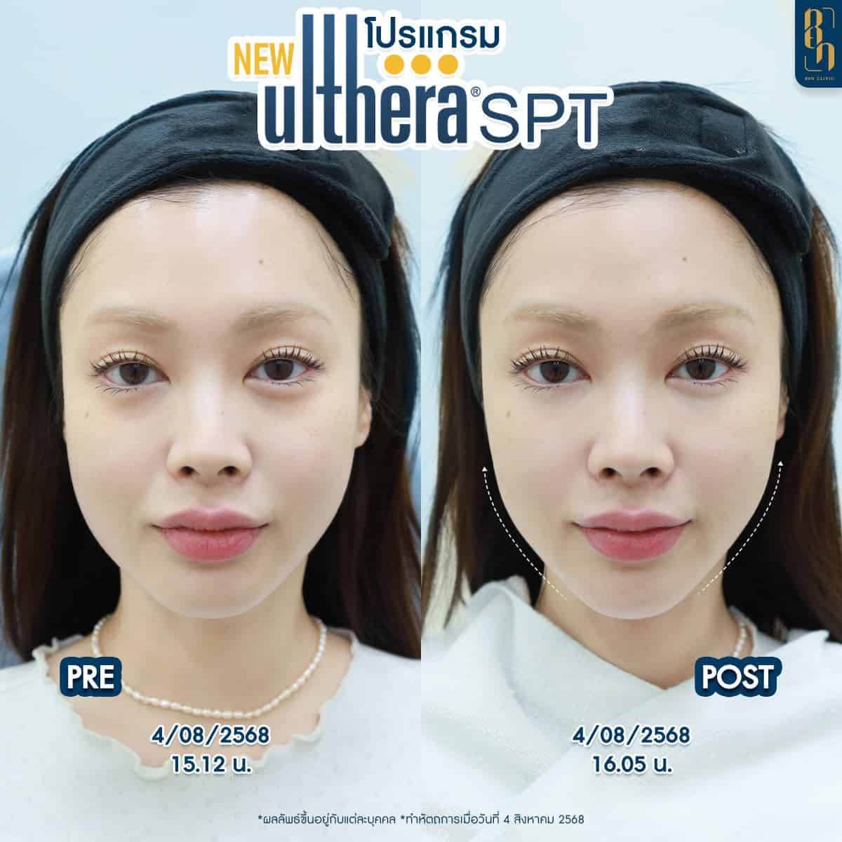 รีวิว hifu