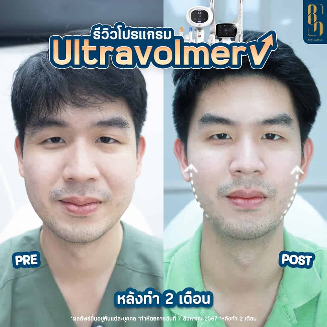 แก้หน้าบาน