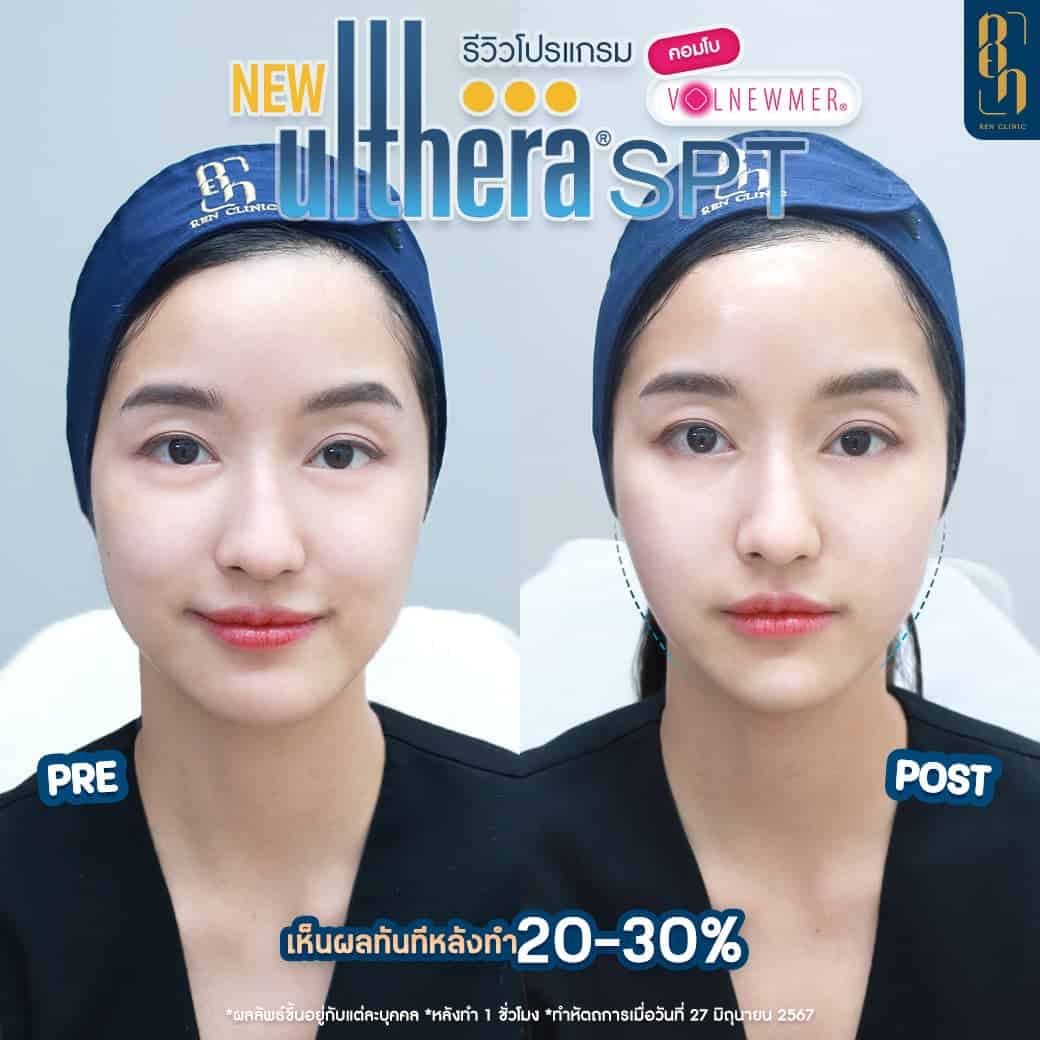 วิธีแก้หน้าบาน