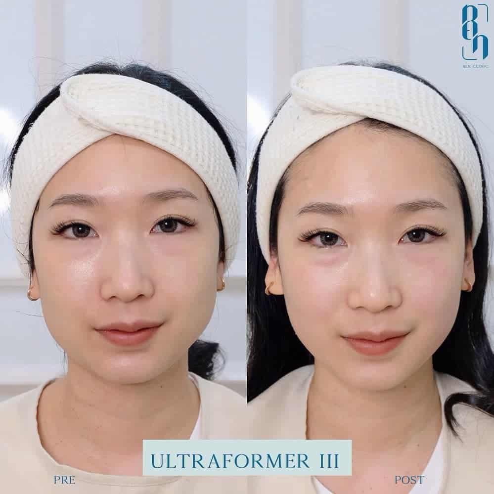 Ultraformer III รีวิว