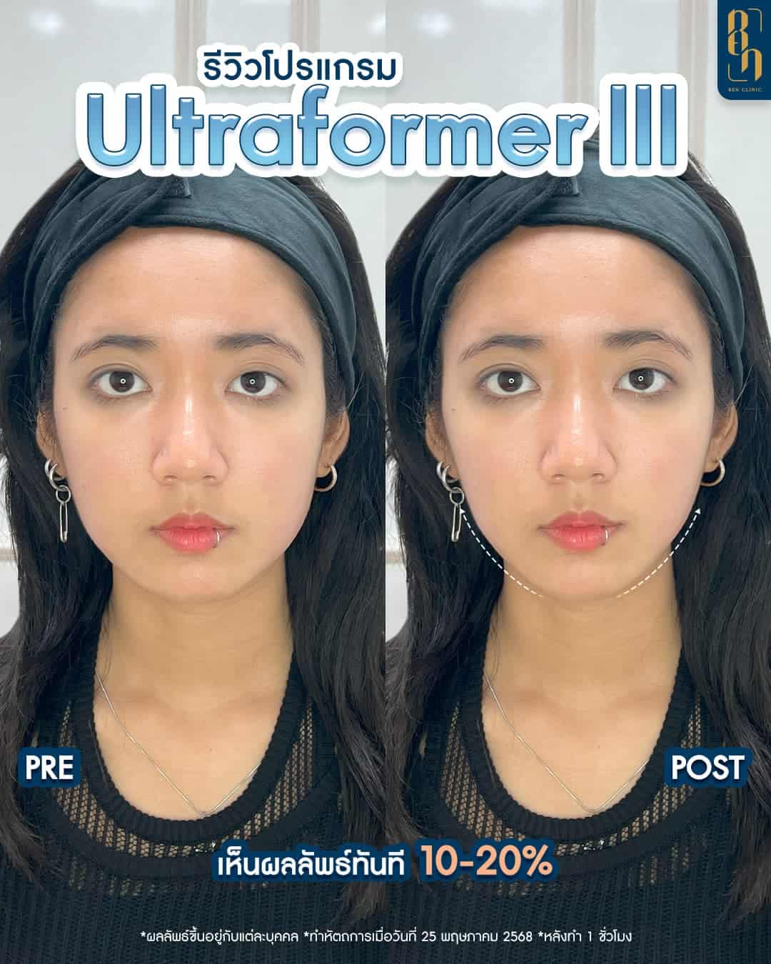 Ultraformer MPT VS. III รีวิว