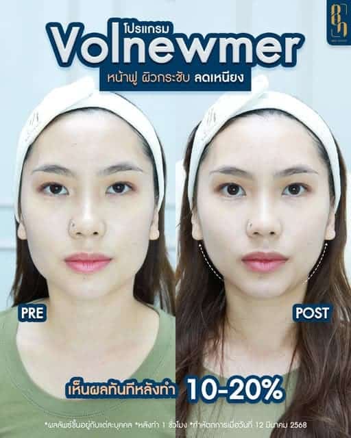 RF ยกกระชับหน้า รีวิว