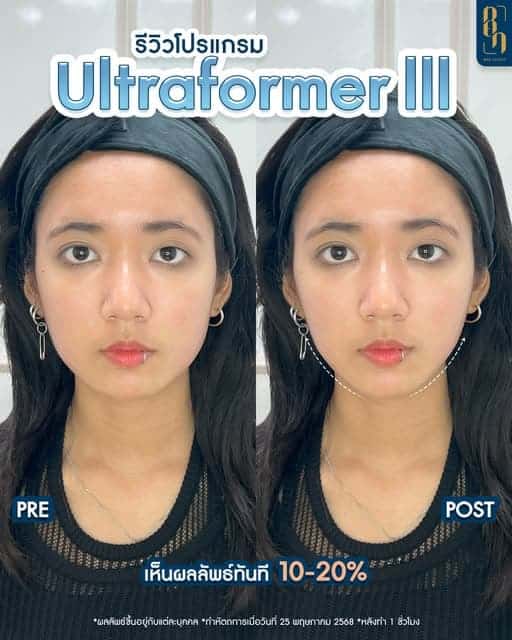 รีวิว Ultraformer III