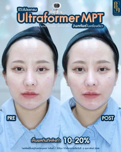 รีวิว Ultraformer MPT VS. III
