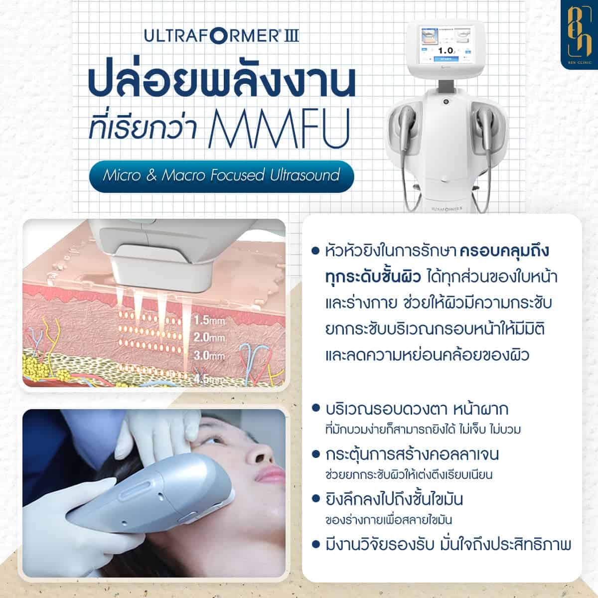 โปรแกรม Ultraformer III ทำงานยังไง