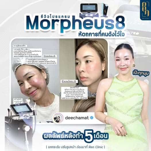 เครื่อง RF ตัวไหนดี