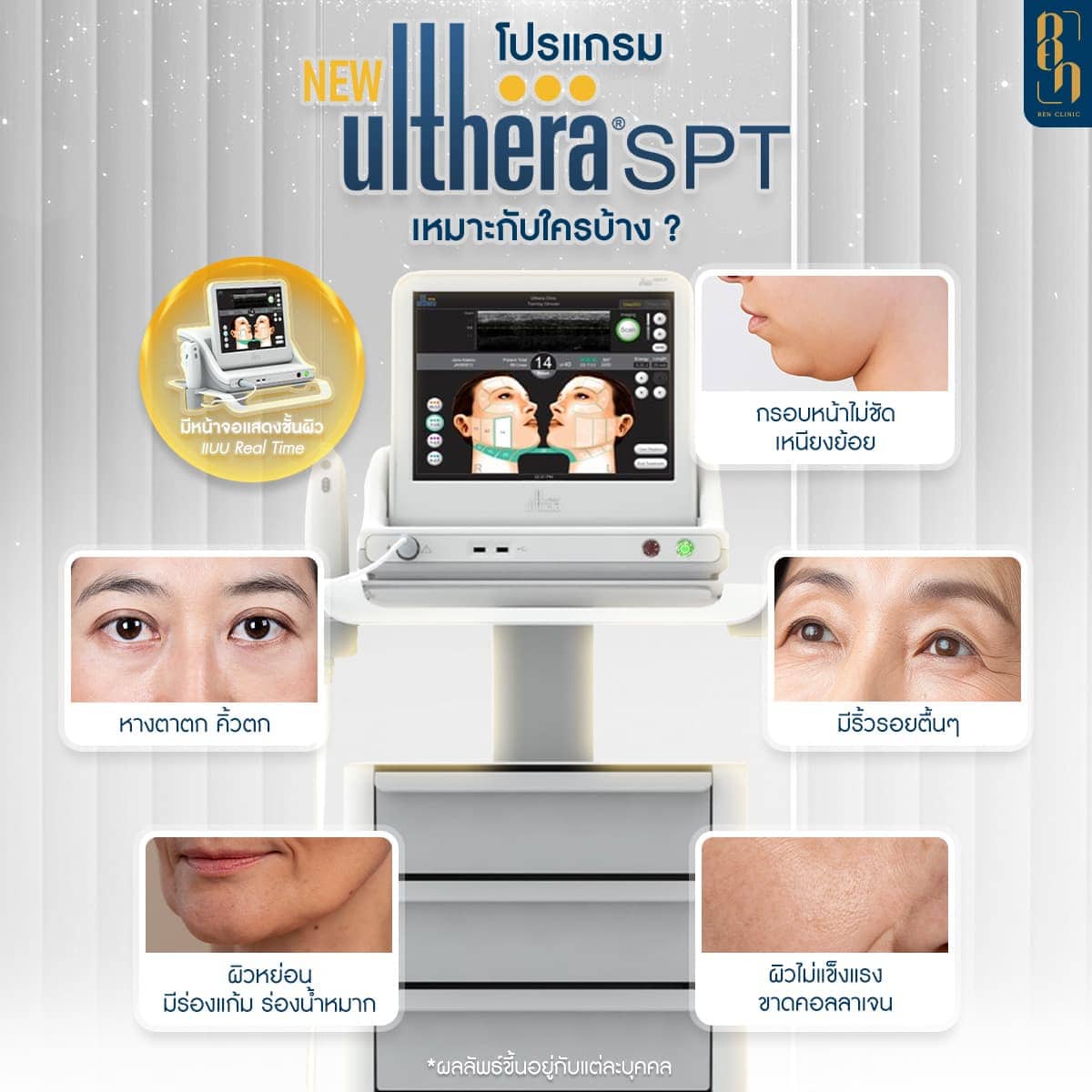 โปรแกรม Ulthera SPT