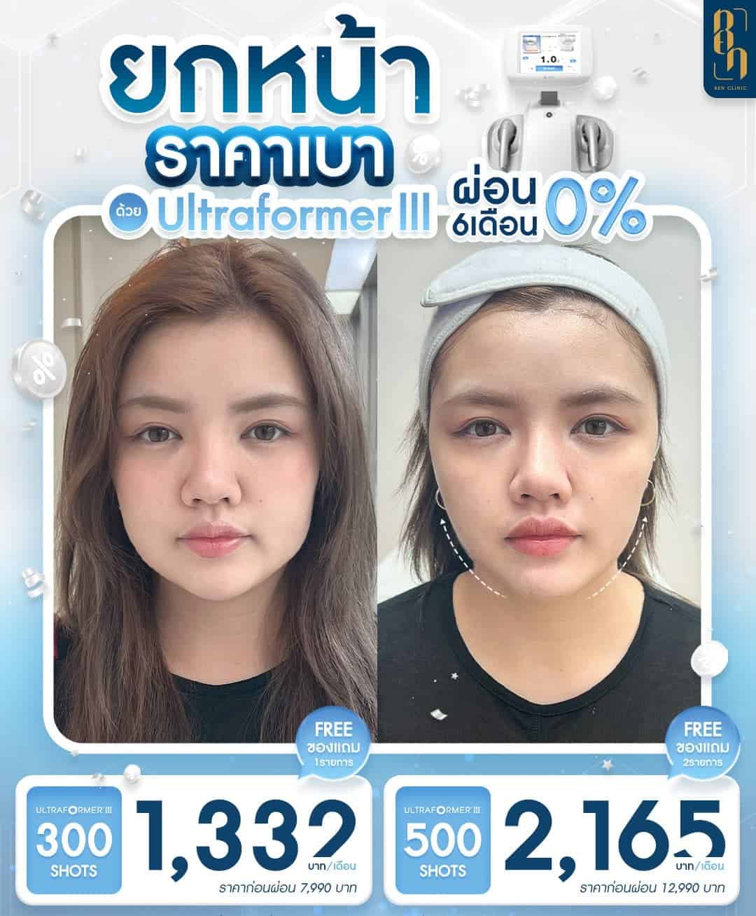 ใครที่ควรทำ Ultraformer III