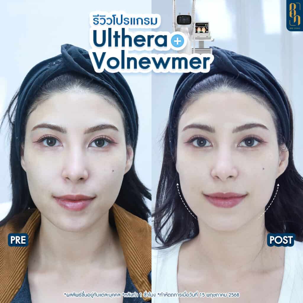 ผลลัพธ์หลังใช้ hifu volnewmer