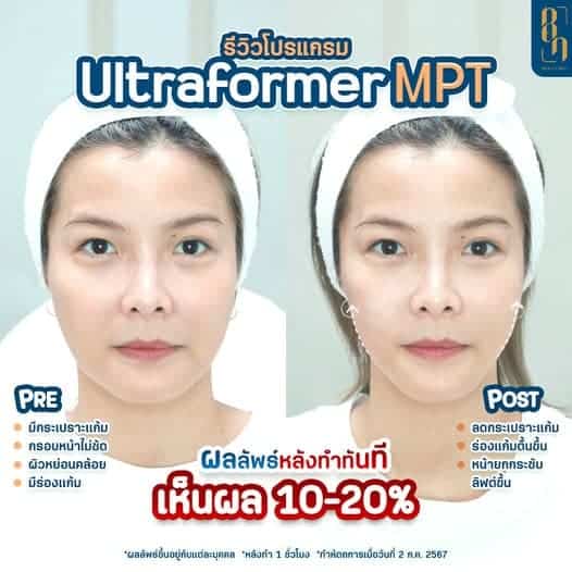 รีวิวการทำ hifu จากโปรแกรม ultraformer mpt