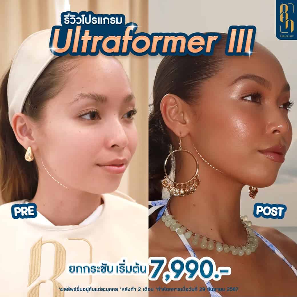 HIFU รีวิว