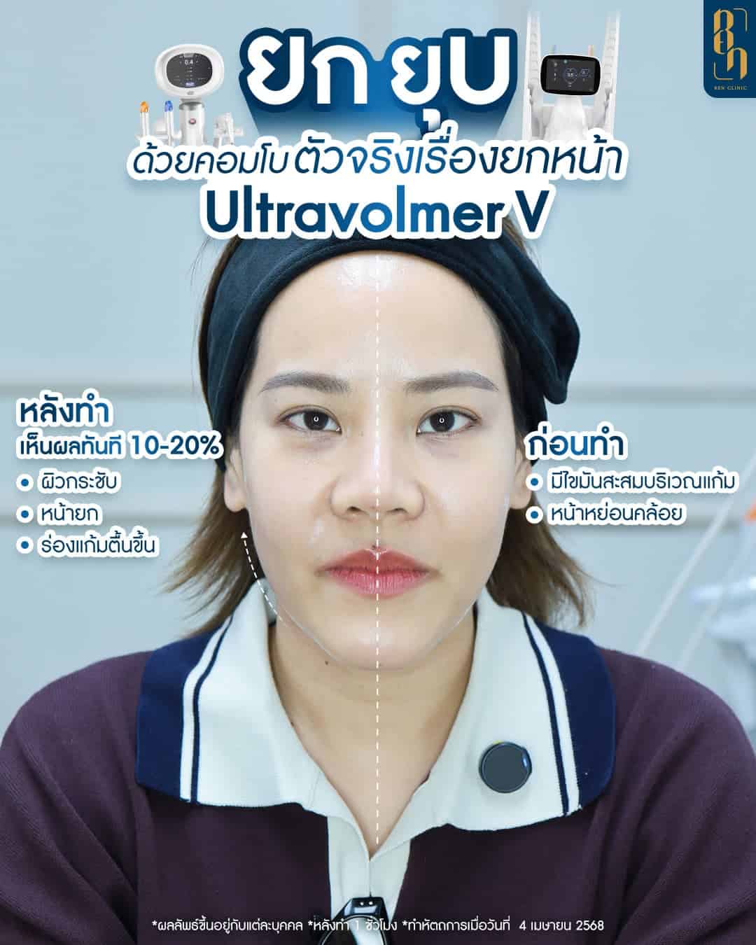 ทําไฮฟู กี่วันเห็นผล