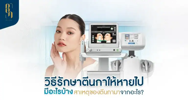 crow-feets ตีนกา