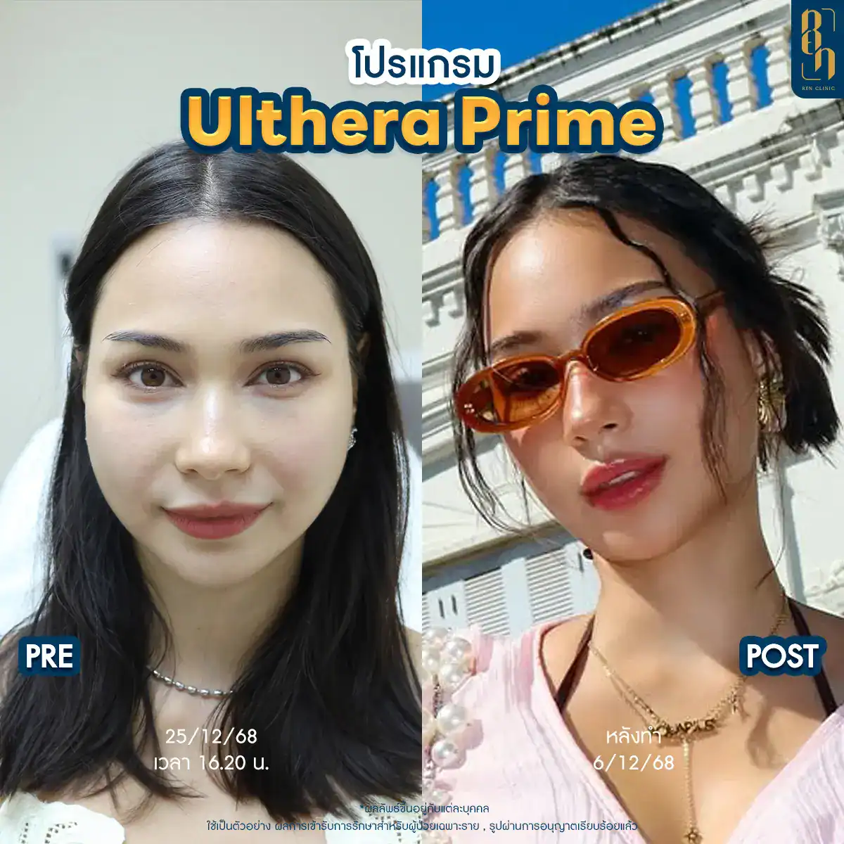 โปรแกรม Ulthera Prime